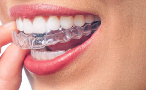 Invisalign 09 1