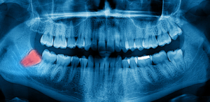 Wisdom teeth