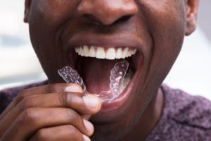 retainers